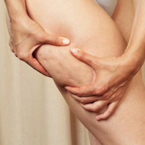 cellulite, what is cellulite, what causes cellulite, cellulitis, pictures of cellulite, cellulite pictures, cellulite photos